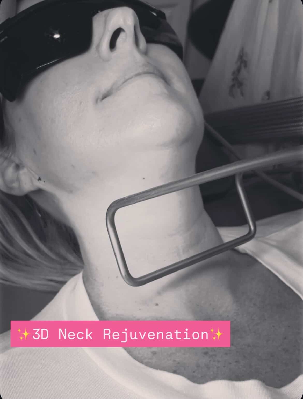 Body Tightening Patient1